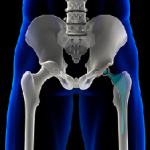 artificial hip